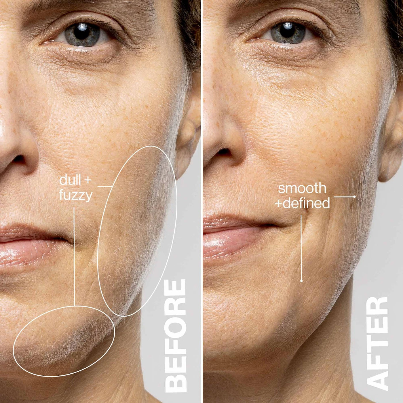 Advanced Ai Epilator
